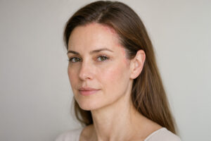 femeie cu zone afectate de dermatita seboreica