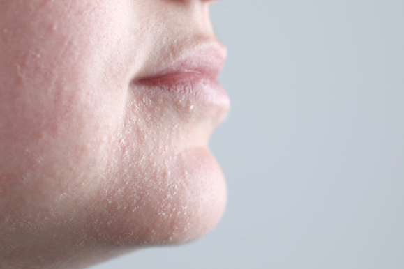 ten uscat, descuamare,dermatita