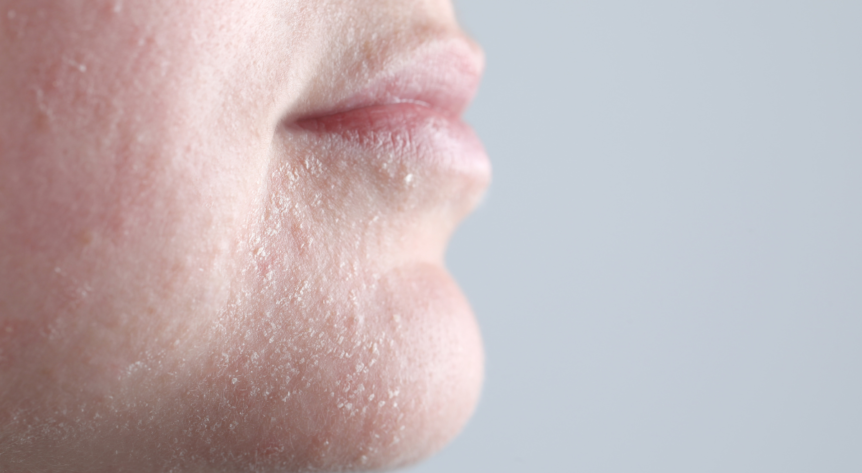 ten uscat, descuamare,dermatita