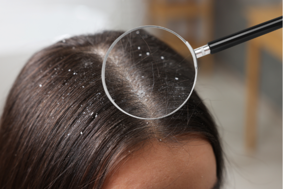 scalp uscatb cu cojite