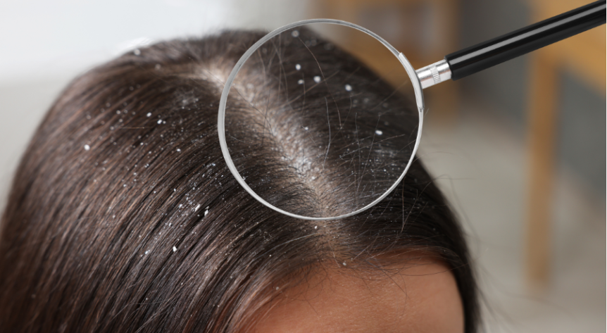 scalp uscatb cu cojite