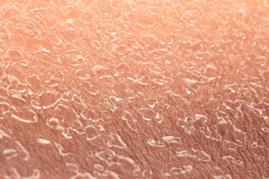 piele uscata si descuamata