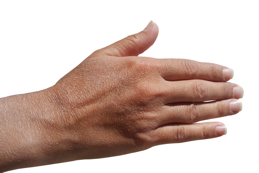 mana cu piele uscata